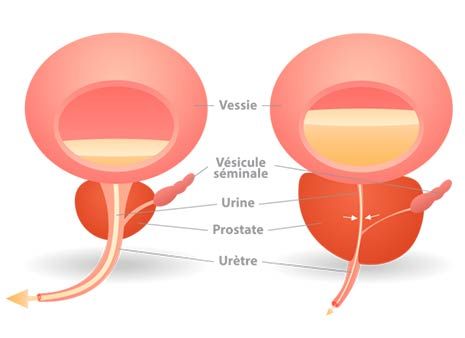 Illustration troubles de la prostate